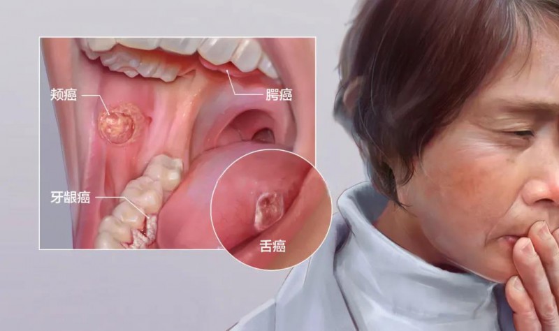 口腔癌手术过程图解图片